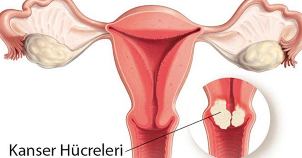 Kısaca rahim ağzı-Serviks kanseri hakkında bilinmesi&nbsp;gerekenler