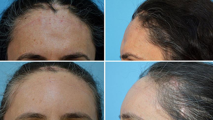 Kayseri’de 3D teknolojisiyle titanyumdan alın kemiği&nbsp;yapıldı