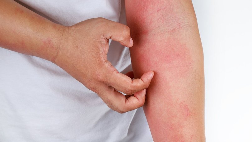 Uyuz nedir? Uyuz Nasıl bulaşır? Salgın Var&nbsp;mı?