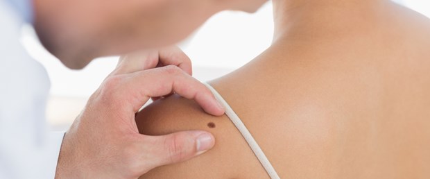 Cilt kanseri hakkında doğru sanılan 8&nbsp;yanlış