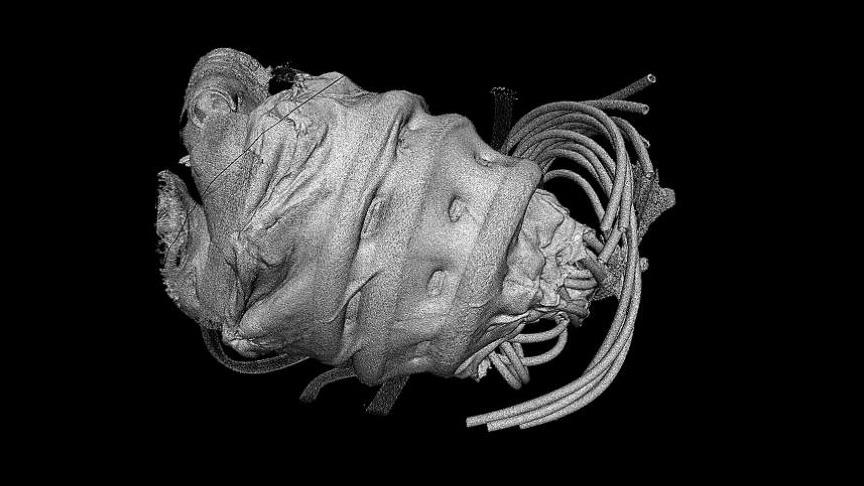 Kalp yetmezliği çeken hastalar için robotla&nbsp;tedavi
