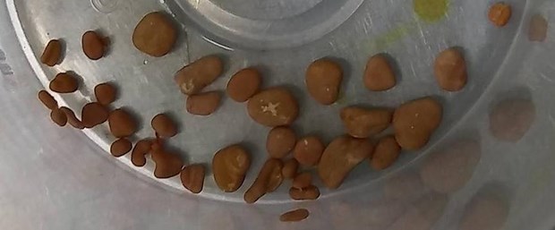 5 aylık bebeğin böbreklerinden 56 taş&nbsp;çıktı