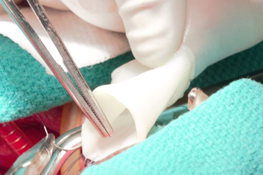 Kalp Cerrahisinde Devrim: Büyüyebilen Yapay&nbsp;Damarlar