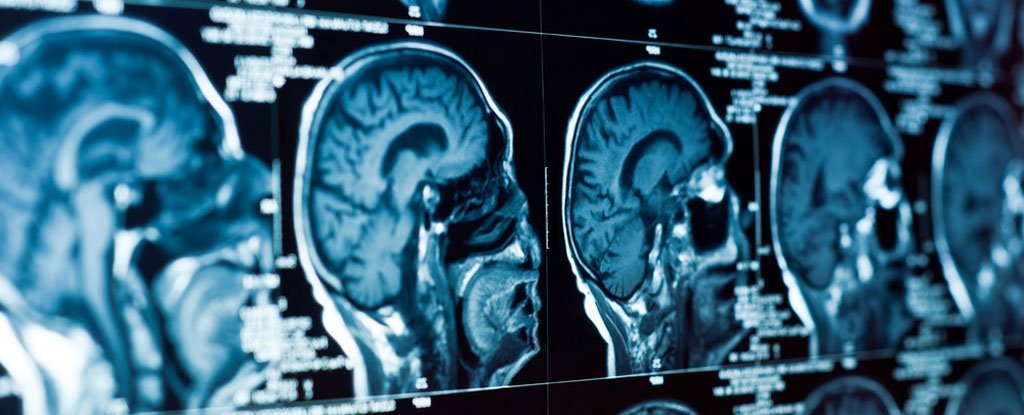 Doktorlar artık beynin sinirsel ağını hedef alarak depresyonu tedavi etme&nbsp;peşindeler
