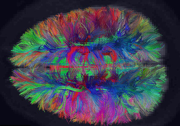 60 yaşındaki 150 kişinin beyin görüntüleri incelendi ve Alzheimer ile ilgili çarpıcı&nbsp;sonuç!