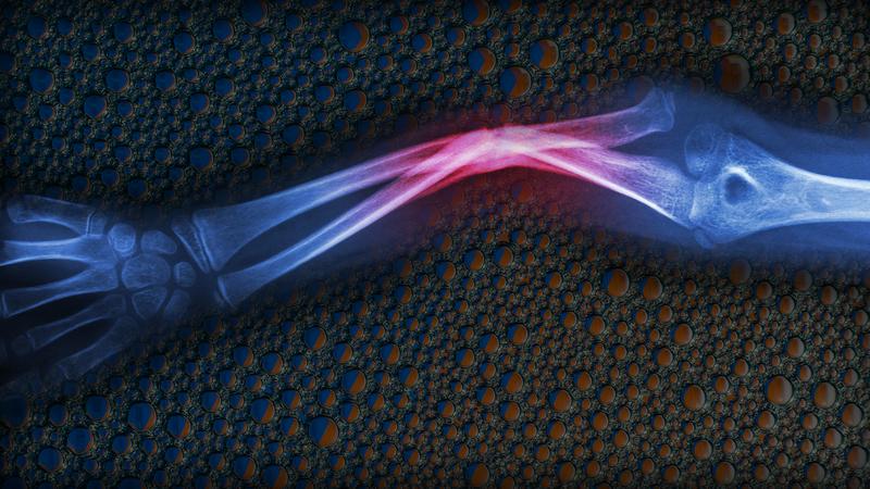 Bu Kabarcıklar, Kırılan Kemikleri&nbsp;İyileştiriyor