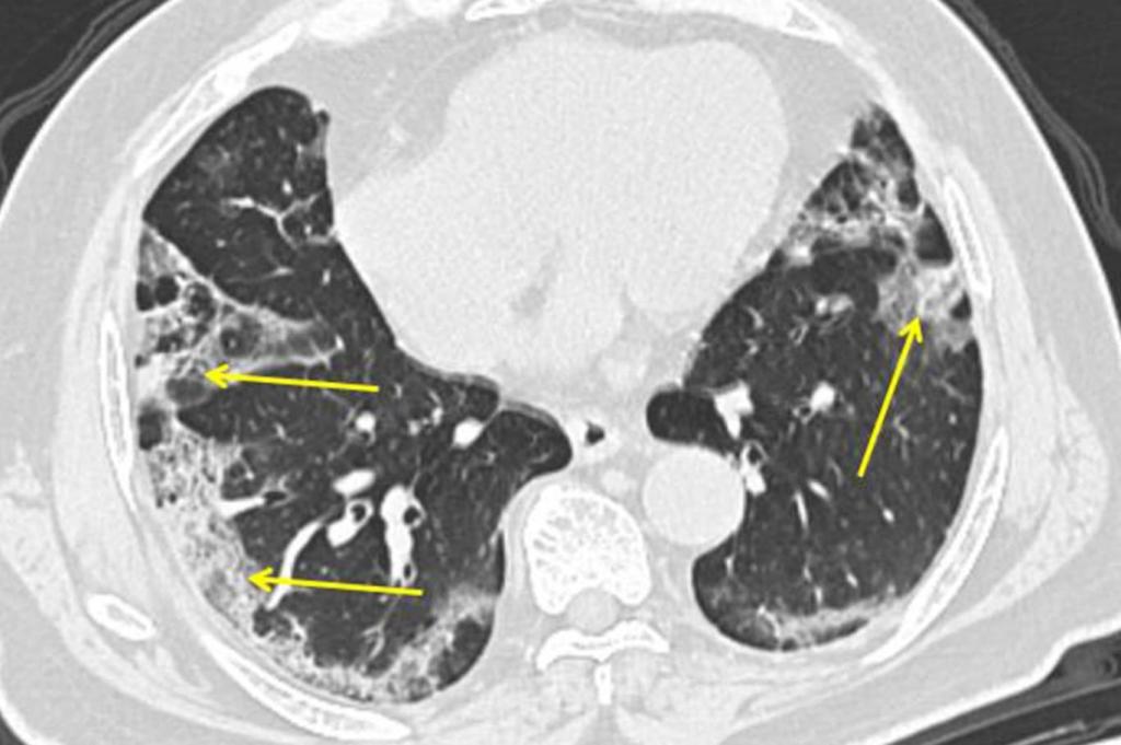Hiç belirti göstermeyenden en ağırına 4 Kovid-19 tipi: Virüs akciğere ne&nbsp;yapıyor?