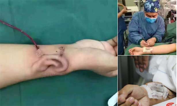 Çinliler Bunu da Yaptı: İnsan Kolunda Yapay&nbsp;Kulak!