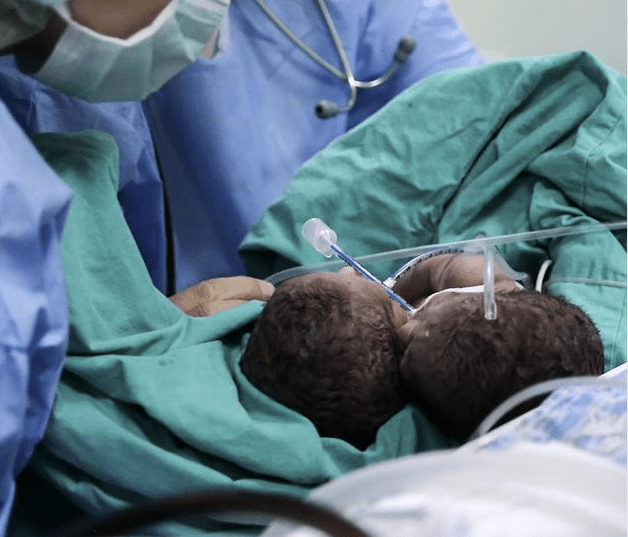 Yapışık ikizler tek karaciğerle&nbsp;doğdu