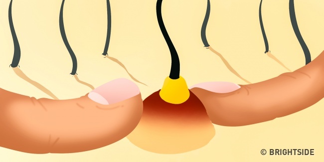 Aknelerle İlgili Duyduklarınızı&nbsp;Unutun